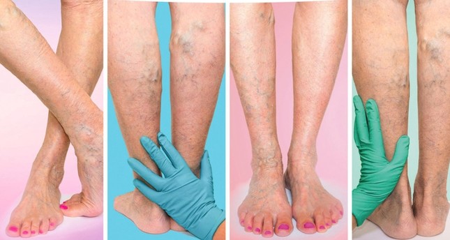 Varicose veins treatment cost in Hyderabad