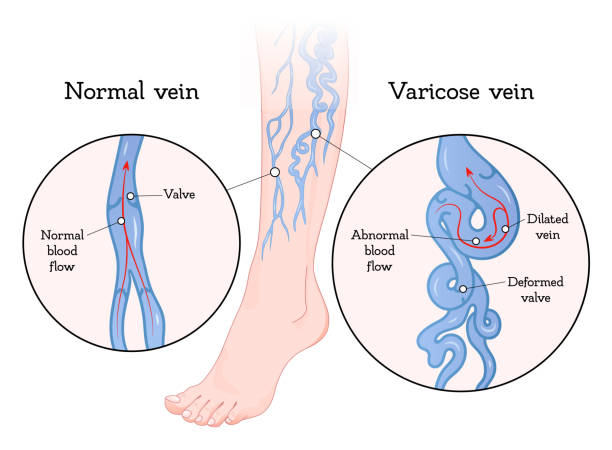varicose veins treatment cost in hyderabad