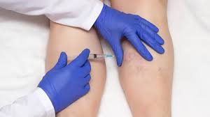 Sclerotherapy Varicose veins surgery cost in hyderabad