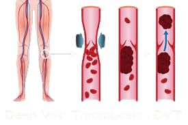 dvt deep vein thrombosis treatment & surgery cost in hyderabad
