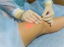 laser varicose veins surgery cost in hyderabad