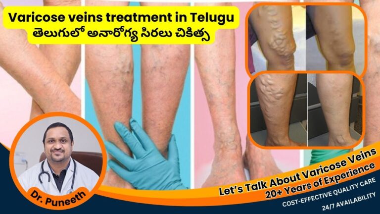 varicose veins treatment in telugu