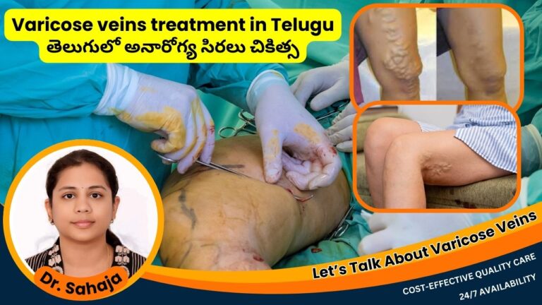 Varicose Veins Treatment in Telugu