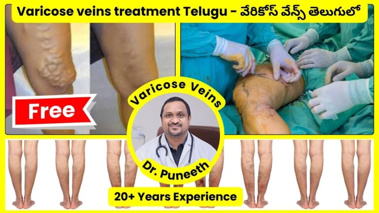 Varicose Veins Treatment in Telugu